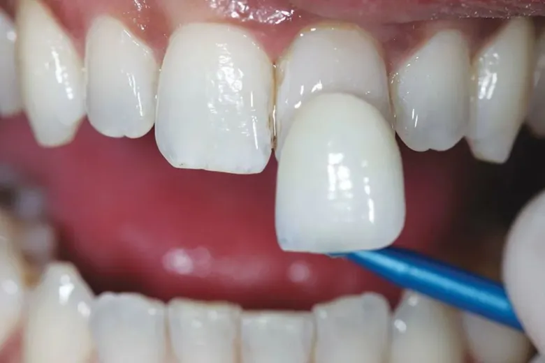 Direct Veneers - Features